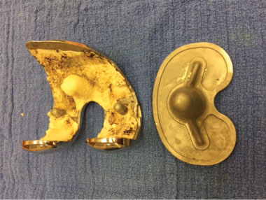 Cement adherent to femoral component but not tibial component.